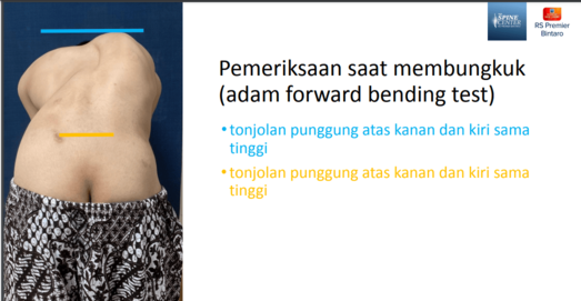 pemeriksaan scoliosis mandiri