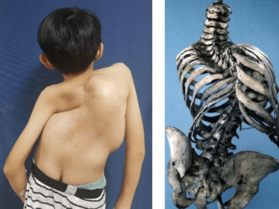 scoliosis