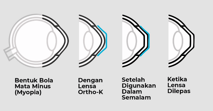 ortho-k